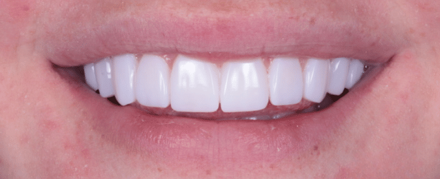 After - Arte Dental