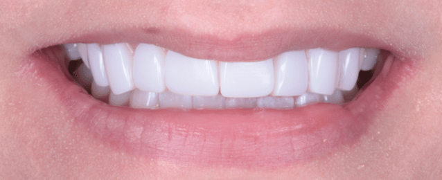 After - Arte Dental