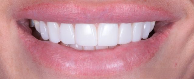 After - Arte Dental