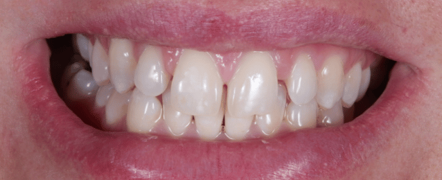 Before -Arte Dental