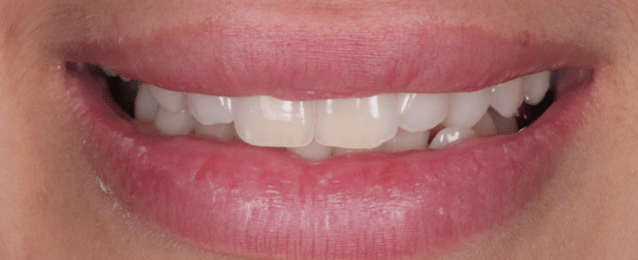 Before -Arte Dental