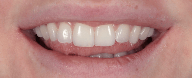 Before -Arte Dental