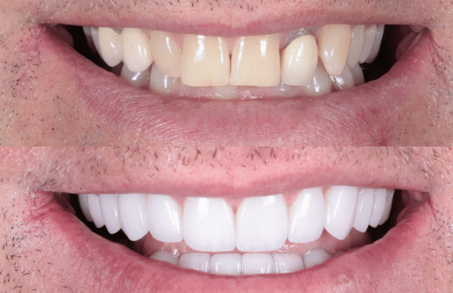 Invisalign-Implant