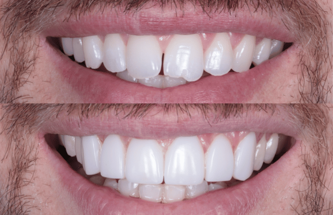 Invisalign-bonding