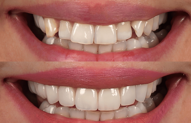 Invisalign-veneers