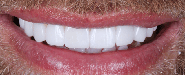 After - Arte Dental