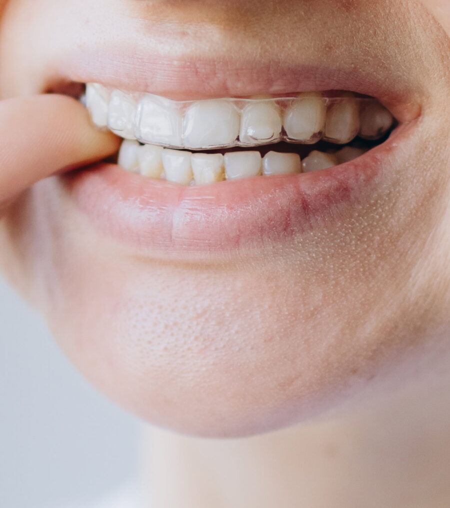 Invisalign and Dental Implants